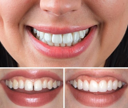 Эстетическая реставрация зубов фото