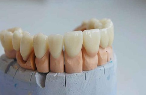 керамической коронки на зуб фото