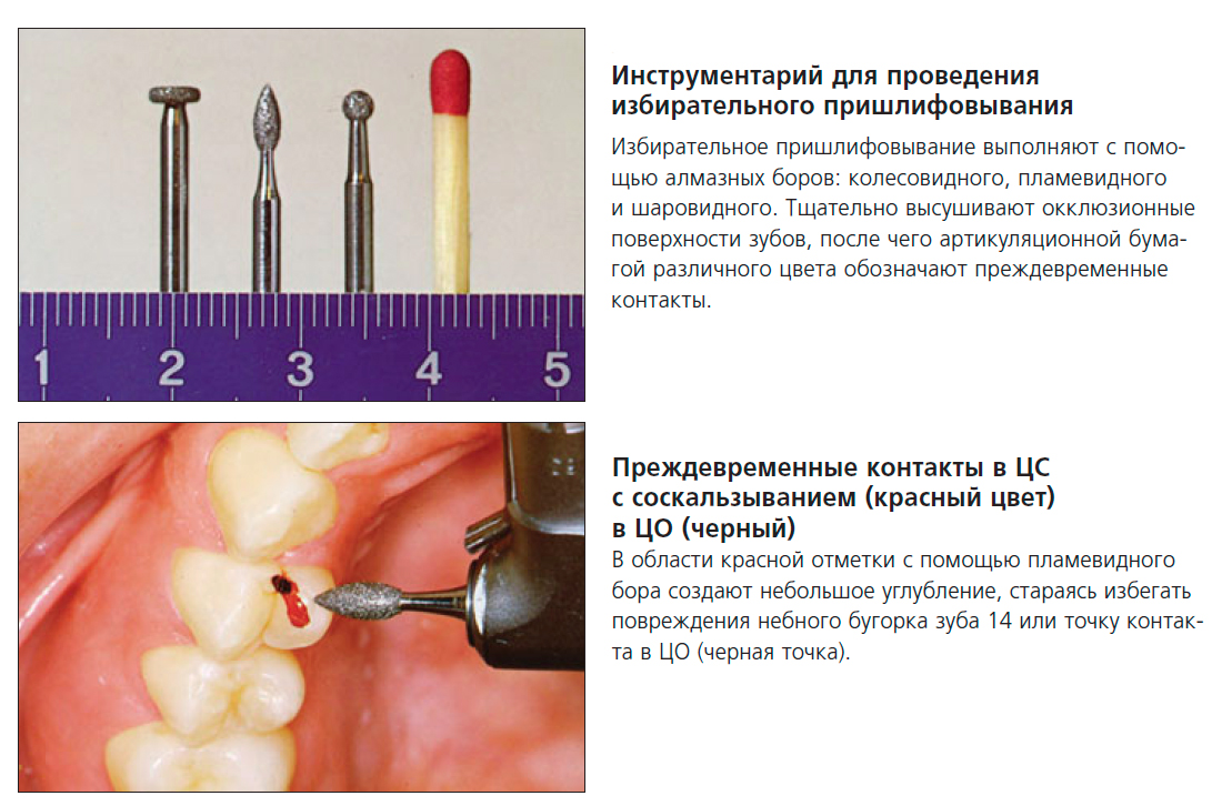 Избирательное пришлифовывание зубов презентация
