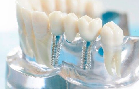 Синус-лифтинг челюсти при имплантации зубов фото